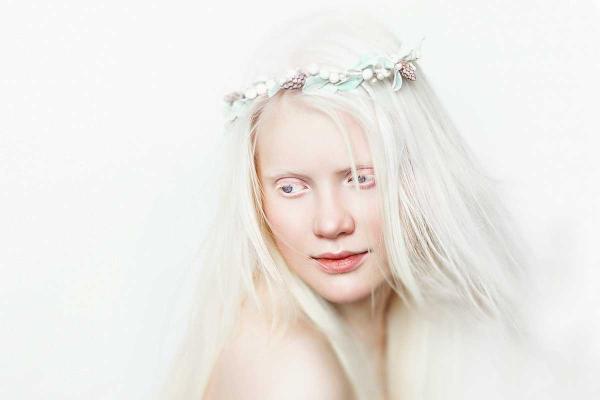 International Albinism Awareness Day